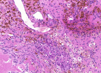 Hematoxylin & Eosin stain